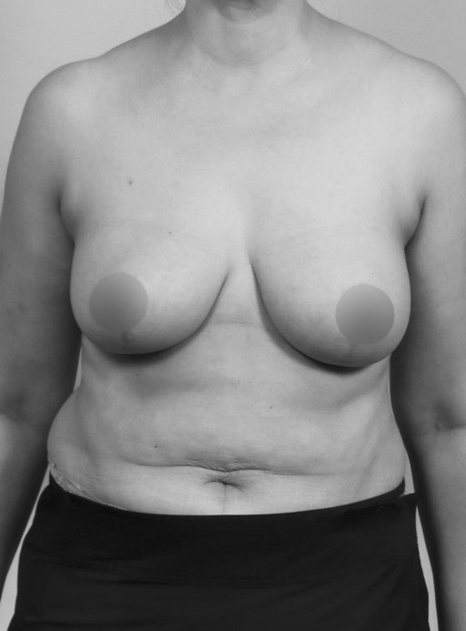 After Breast Reduction