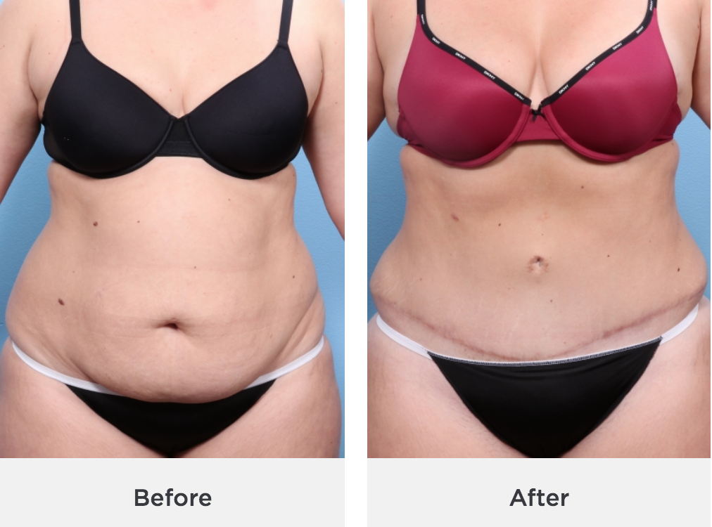 Tummy Tuck Before & After