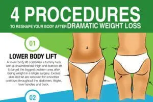 post weight loss infographic