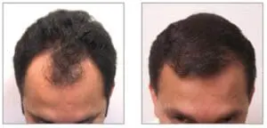 NeoGraft® Hair Restoration