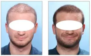 NeoGraft® Hair Restoration