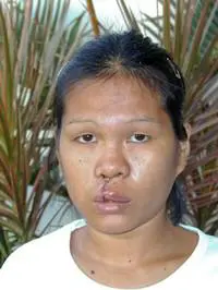 Volunteer Reconstructive Surgery - Case 292 - After