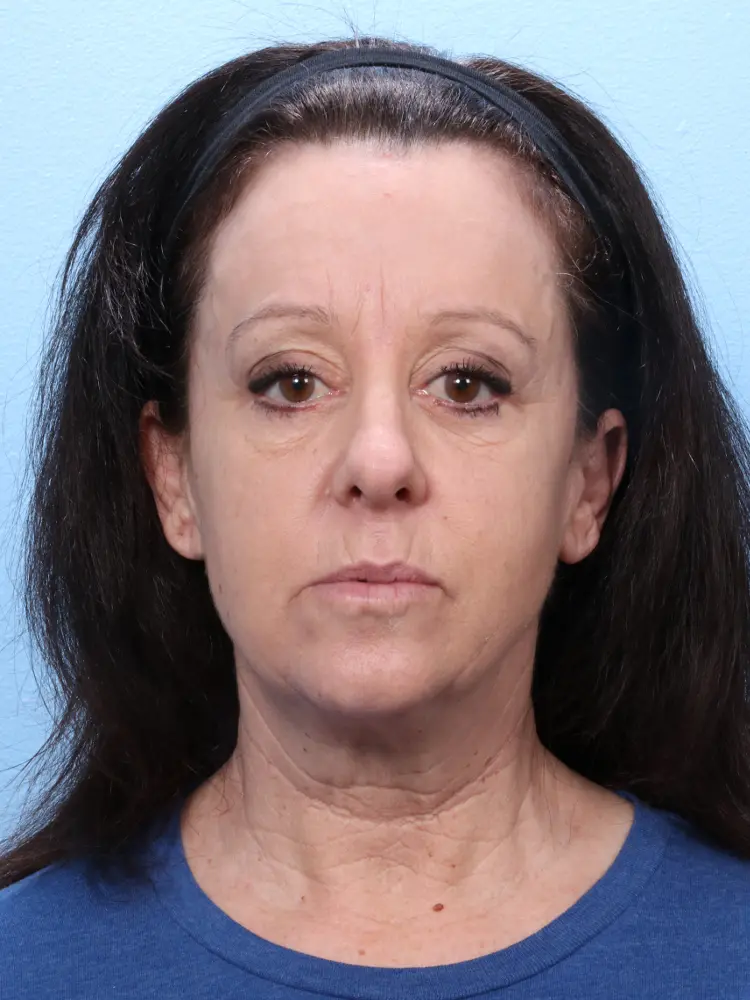 Facelift / Neck Lift - Case 1824 - Before