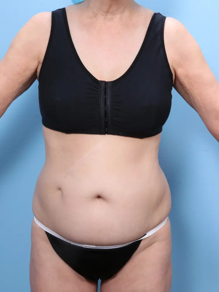 Tummy Tuck - Case 1815 - Before