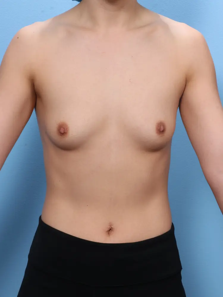 Breast Augmentation - Case 1817 - Before