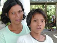 Volunteer Reconstructive Surgery - Case 279 - Before