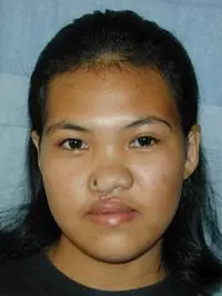 Volunteer Reconstructive Surgery - Case 274 - After