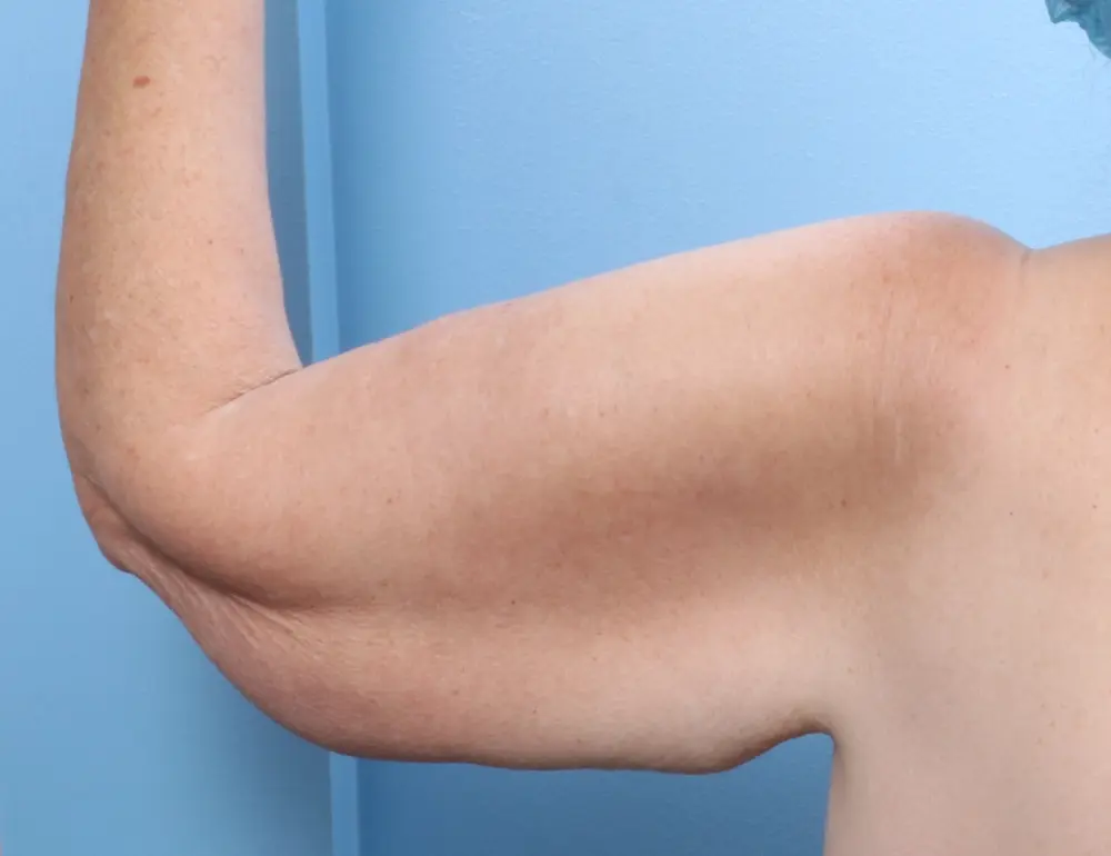 Arm Lift - Case 1808 - Before