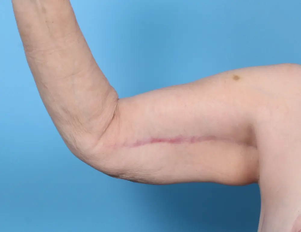 Arm Lift Patient Photo - Case 1808 - after view-1