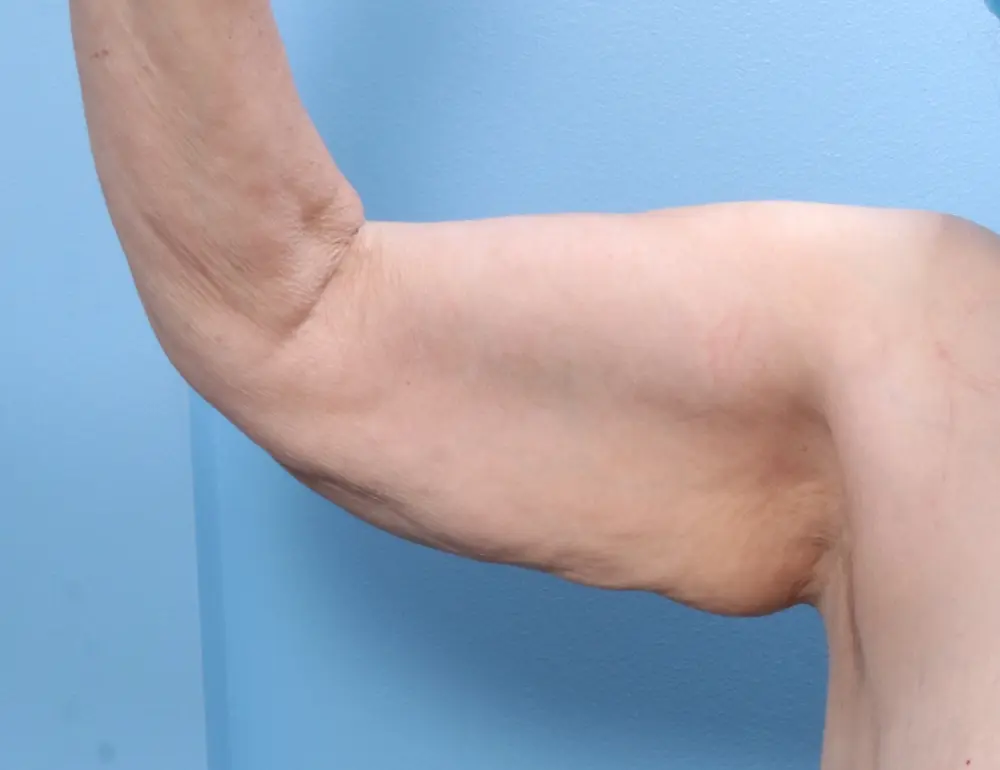 Arm Lift Patient Photo - Case 1808 - before view-1