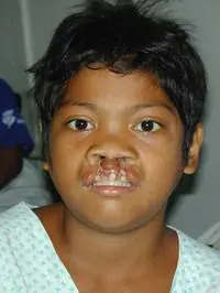 Volunteer Reconstructive Surgery - Case 282 - Before