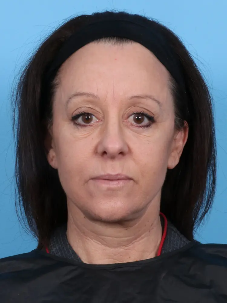 Facelift / Neck Lift - Case 1824 - After