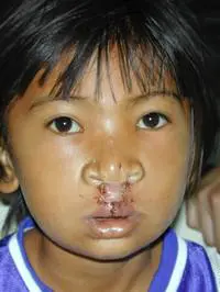 Volunteer Reconstructive Surgery - Case 319 - After