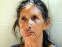 Volunteer Reconstructive Surgery - Case 298 - After