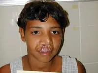 Volunteer Reconstructive Surgery - Case 296 - Before