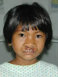 Volunteer Reconstructive Surgery - Case 319 - Before