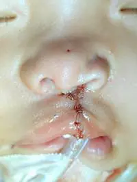 Volunteer Reconstructive Surgery - Case 322 - After