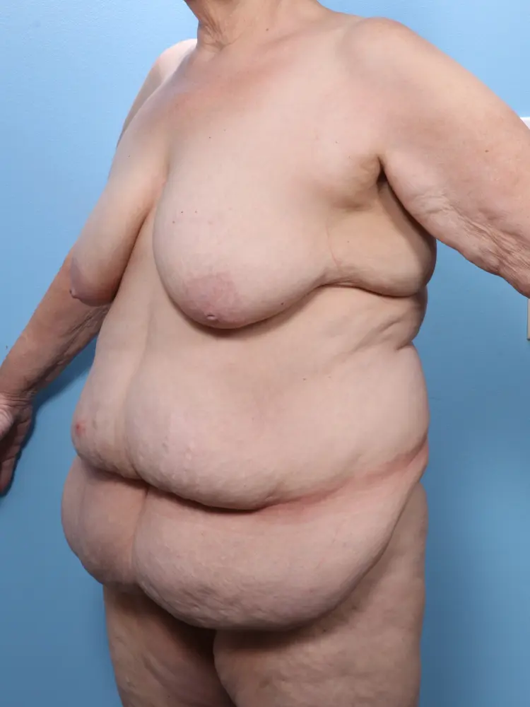 Breast Lift/Reduction w/o Implants Patient Photo - Case 1809 - before view-1