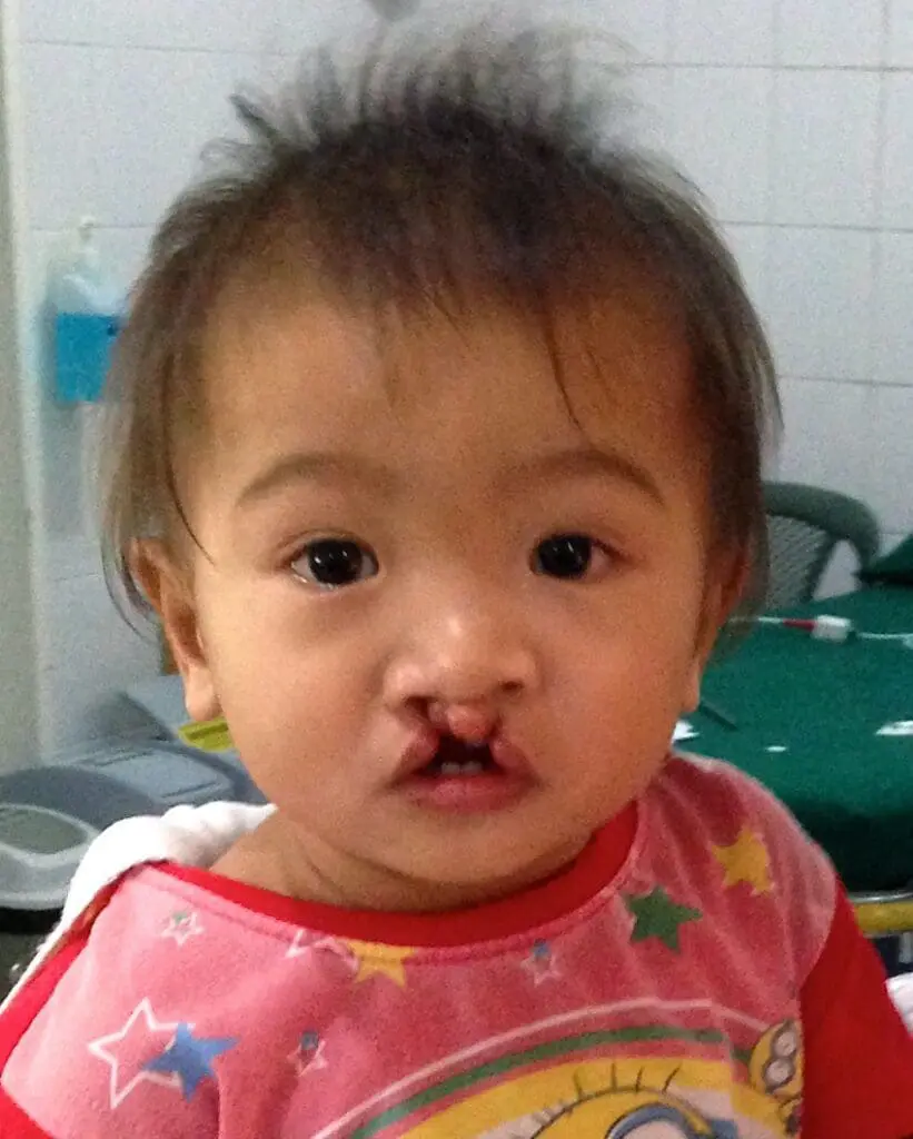 Volunteer Reconstructive Surgery - Case 1486 - Before