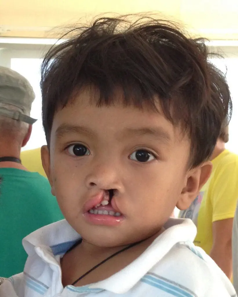 Volunteer Reconstructive Surgery - Case 1489 - Before