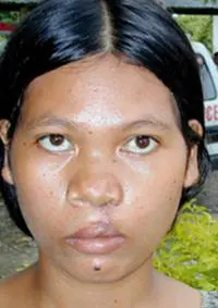 Volunteer Reconstructive Surgery - Case 331 - After