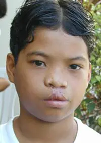 Volunteer Reconstructive Surgery - Case 326 - After