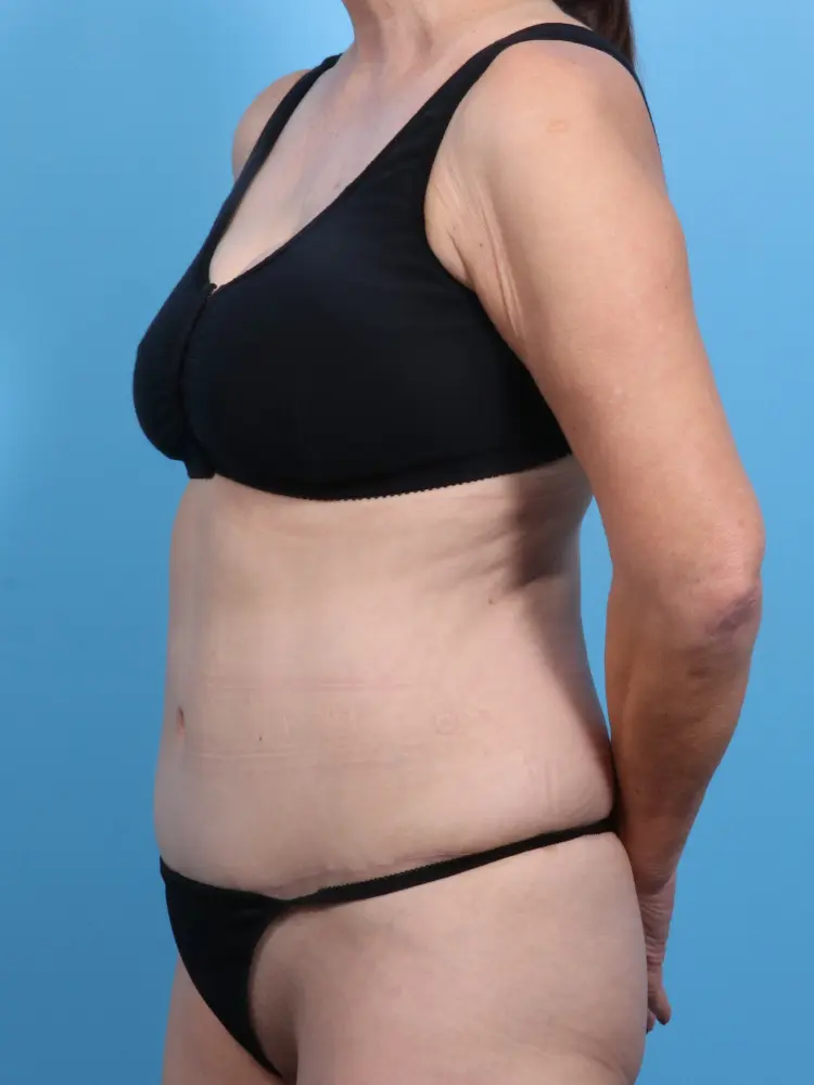 Tummy Tuck Patient Photo - Case 1815 - after view-1