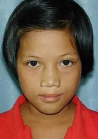 Volunteer Reconstructive Surgery - Case 330 - After