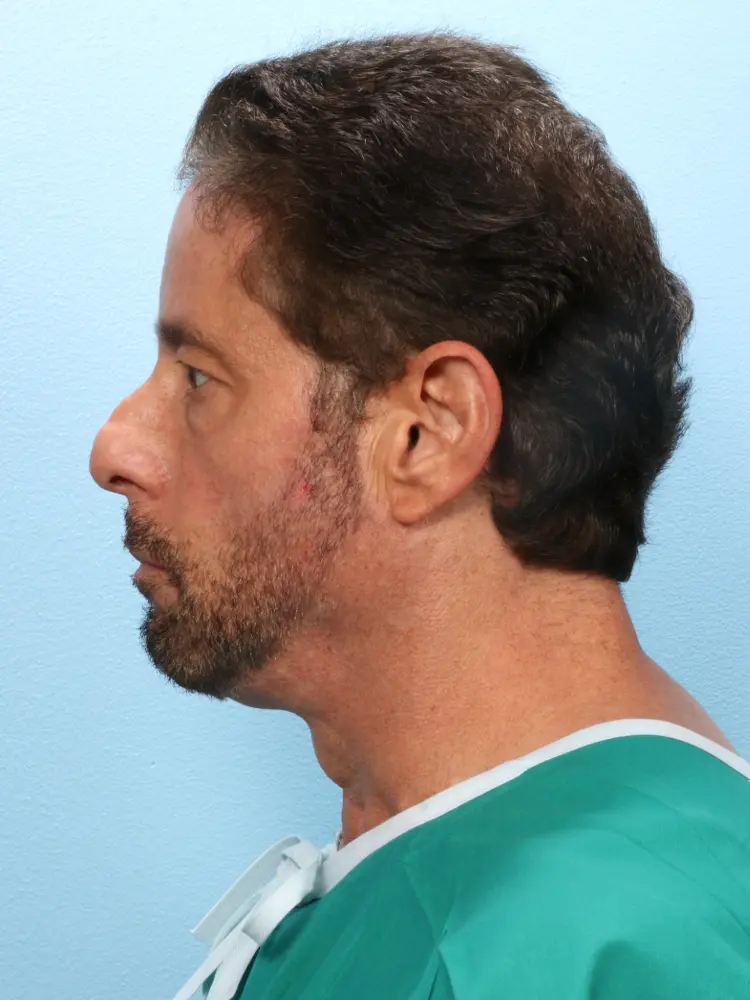 Male Facial Surgery Patient Photo - Case 1819 - before view-2