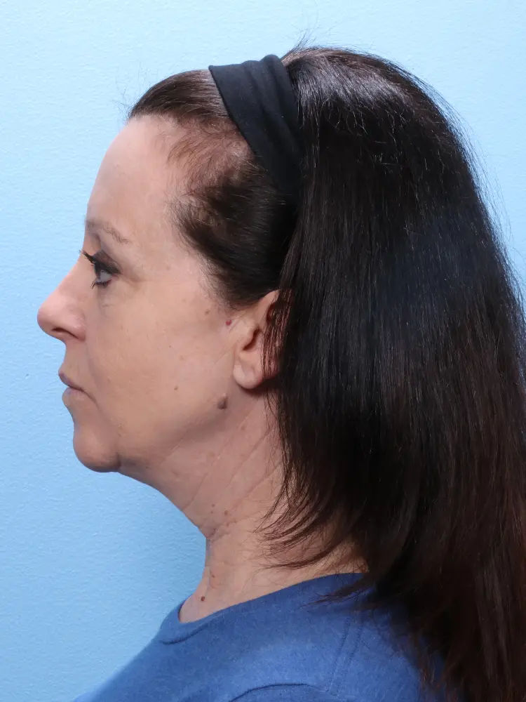 Facelift / Neck Lift Patient Photo - Case 1824 - before view-2