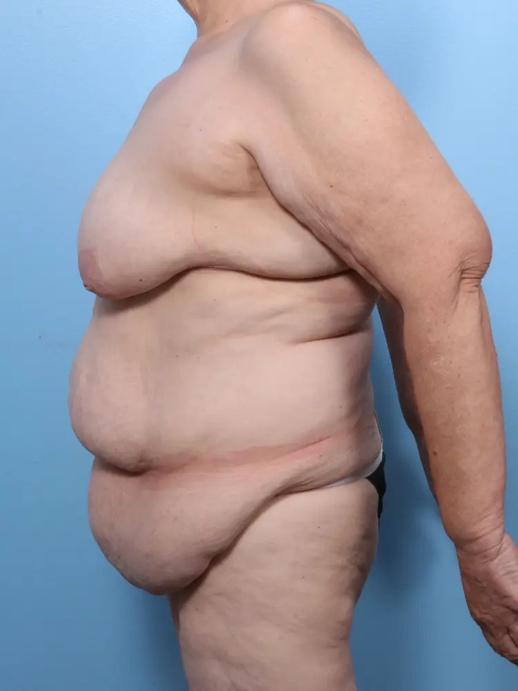 Tummy Tuck Patient Photo - Case 1809 - before view-2