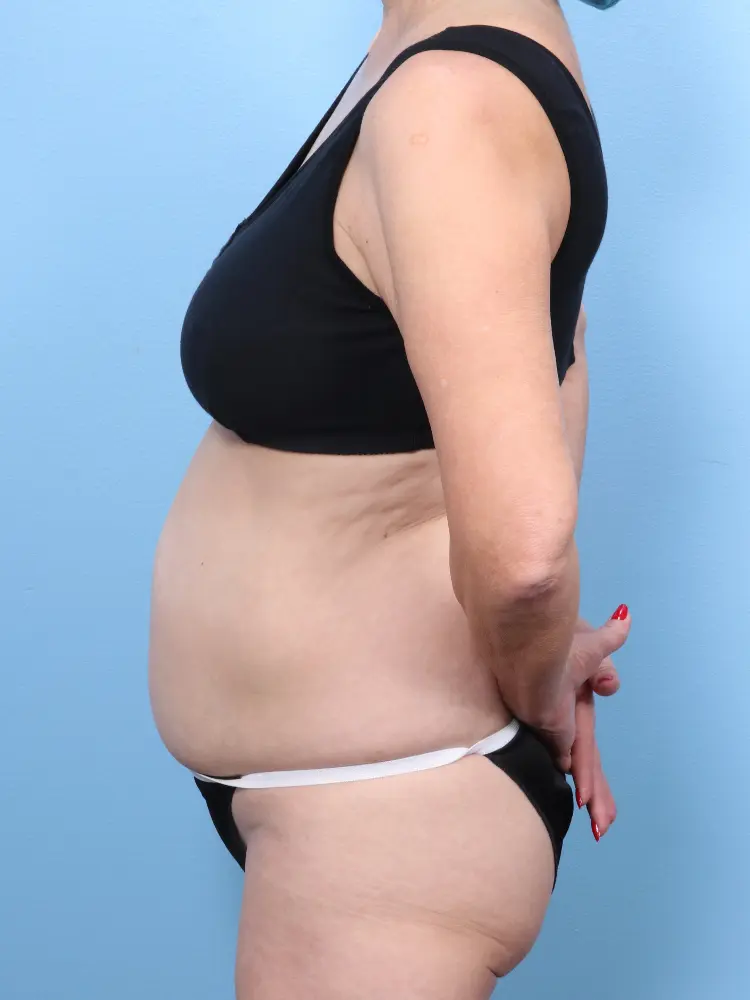 Tummy Tuck Patient Photo - Case 1815 - before view-2