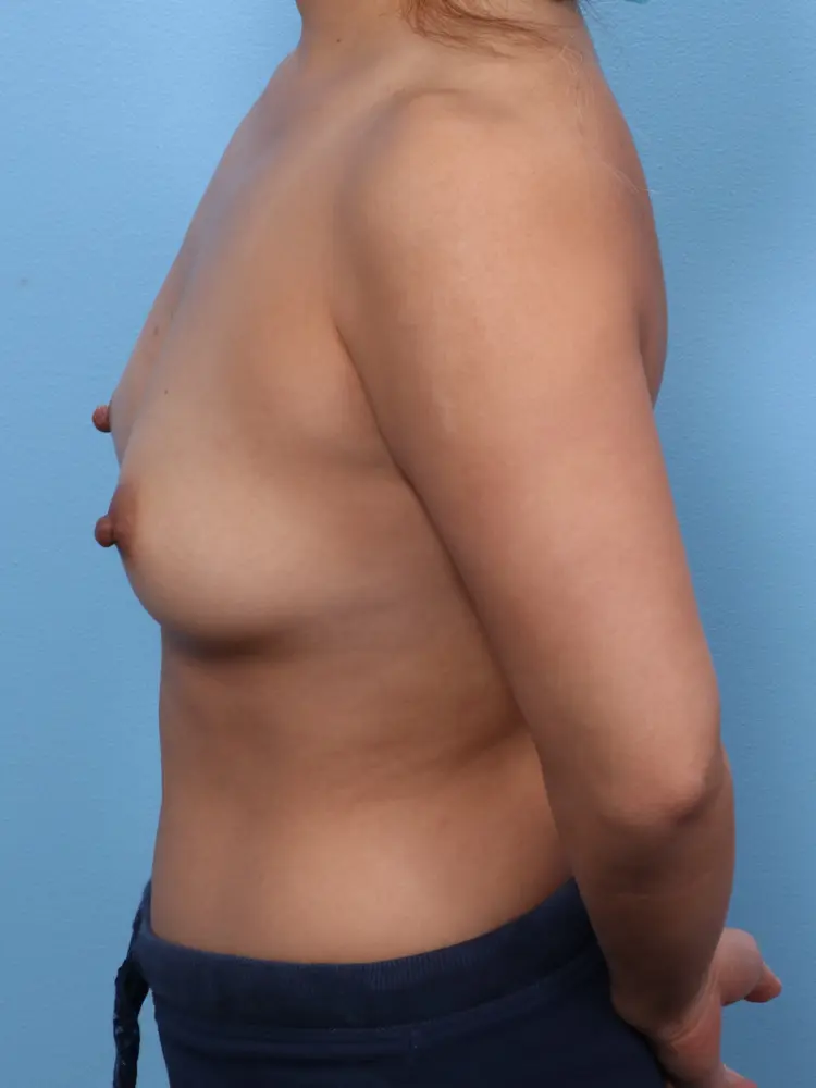 Breast Augmentation Patient Photo - Case 1818 - before view-2