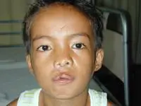 Volunteer Reconstructive Surgery - Case 280 - After