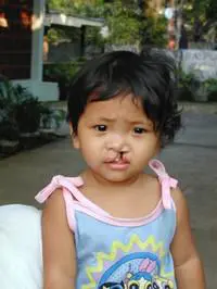 Volunteer Reconstructive Surgery - Case 322 - Before