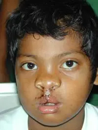 Volunteer Reconstructive Surgery - Case 282 - After