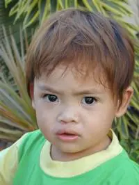 Volunteer Reconstructive Surgery - Case 323 - After