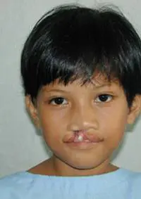 Volunteer Reconstructive Surgery - Case 330 - Before