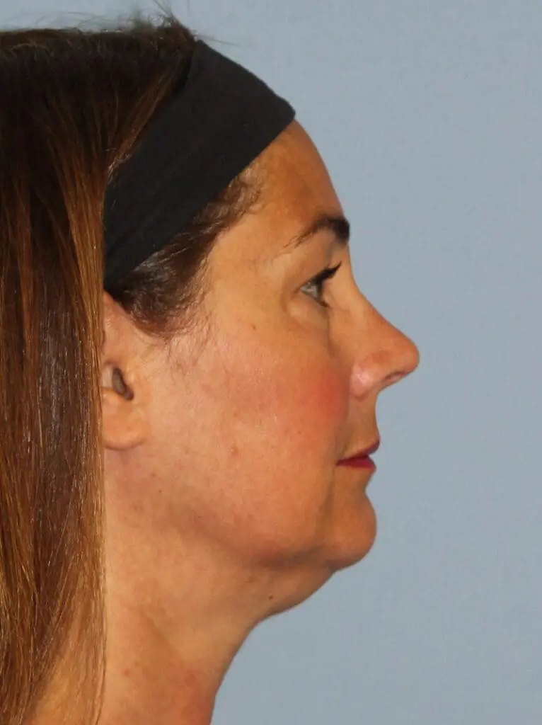 CoolSculpting - Case 1508 - Before