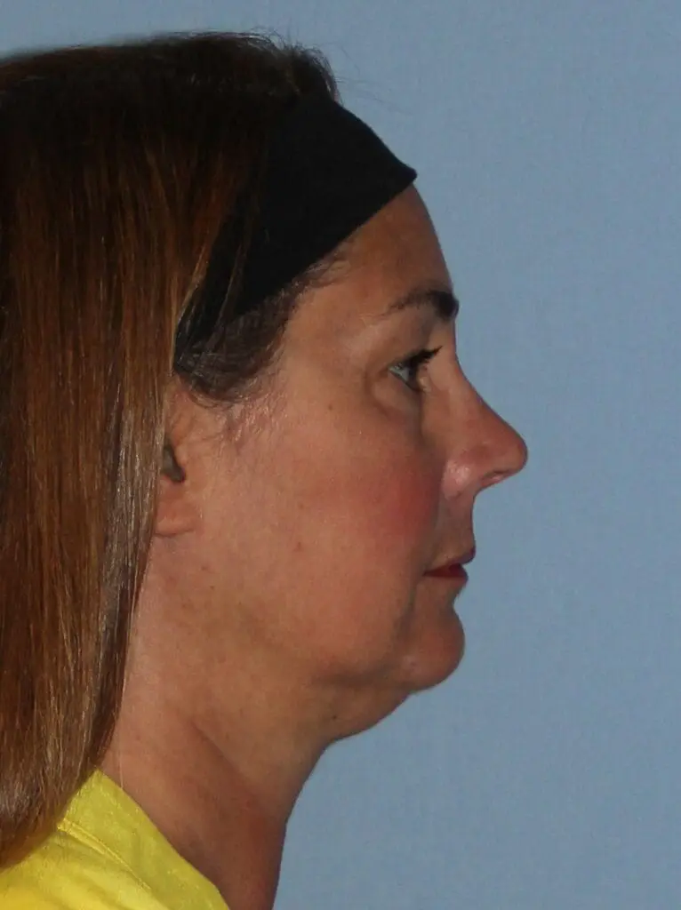 CoolSculpting - Case 1508 - After