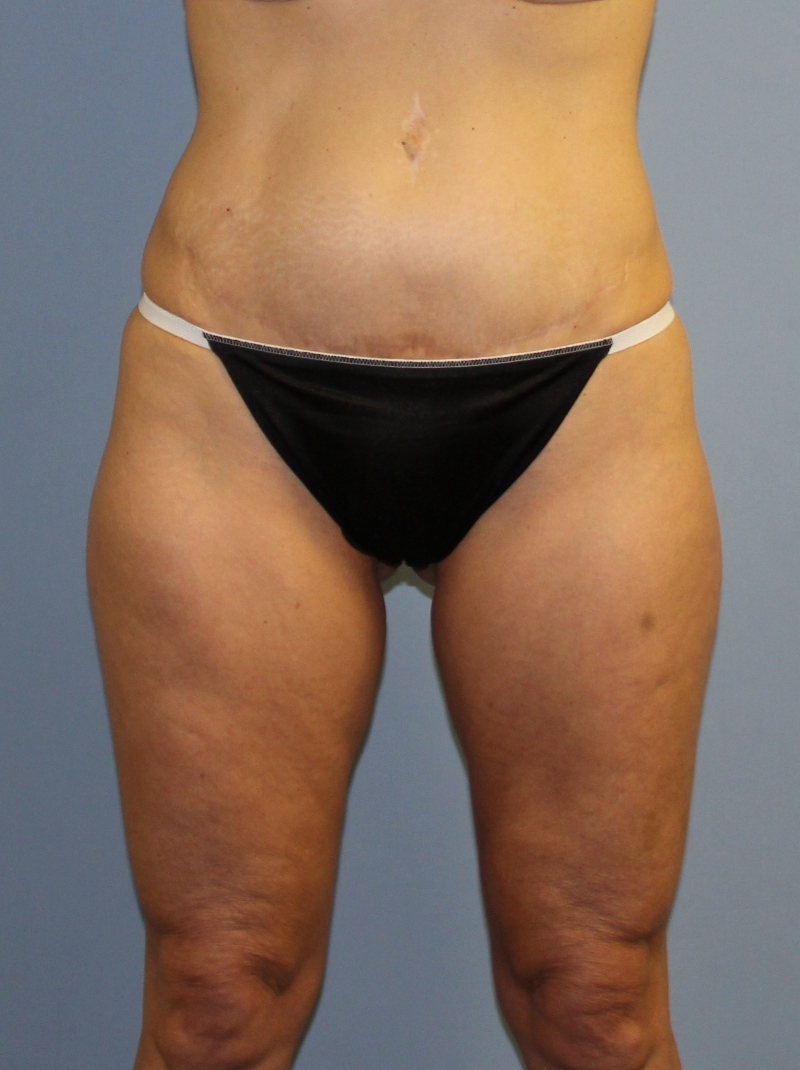 CoolSculpting Patient Photo - Case 1510 - before view-1