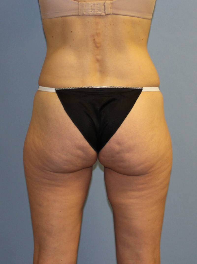 Before CoolSculpting