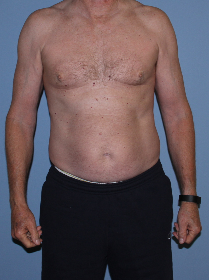 Before CoolSculpting