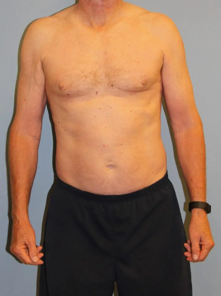 CoolSculpting - Case 1513 - After