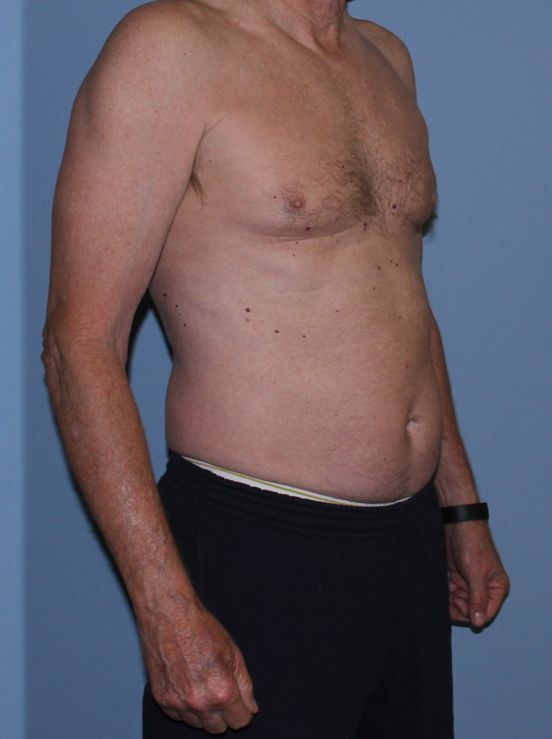 CoolSculpting Patient Photo - Case 1513 - before view-1