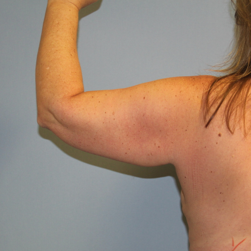 CoolSculpting Patient Photo - Case 1585 - before view-1