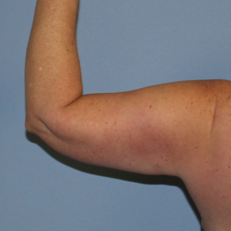 CoolSculpting Patient Photo - Case 1585 - after view-1