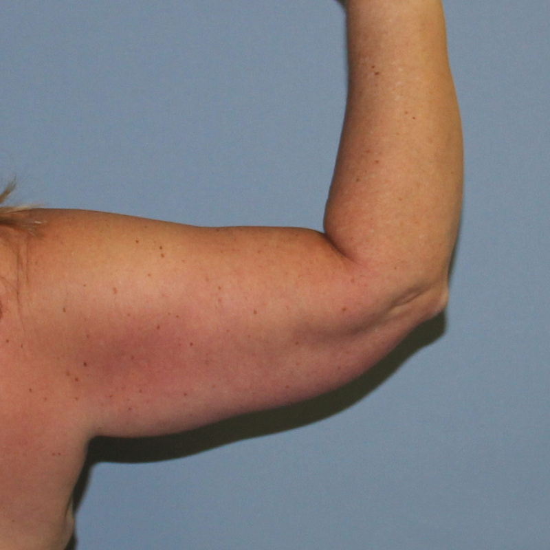 CoolSculpting - Case 1585 - After