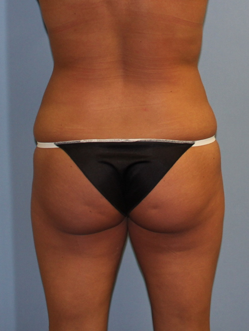 CoolSculpting - Case 1586 - After