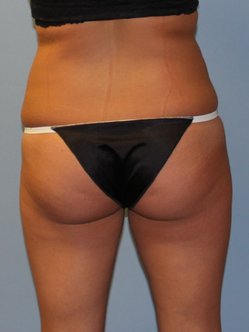 CoolSculpting Patient Photo - Case 1586 - after view-1